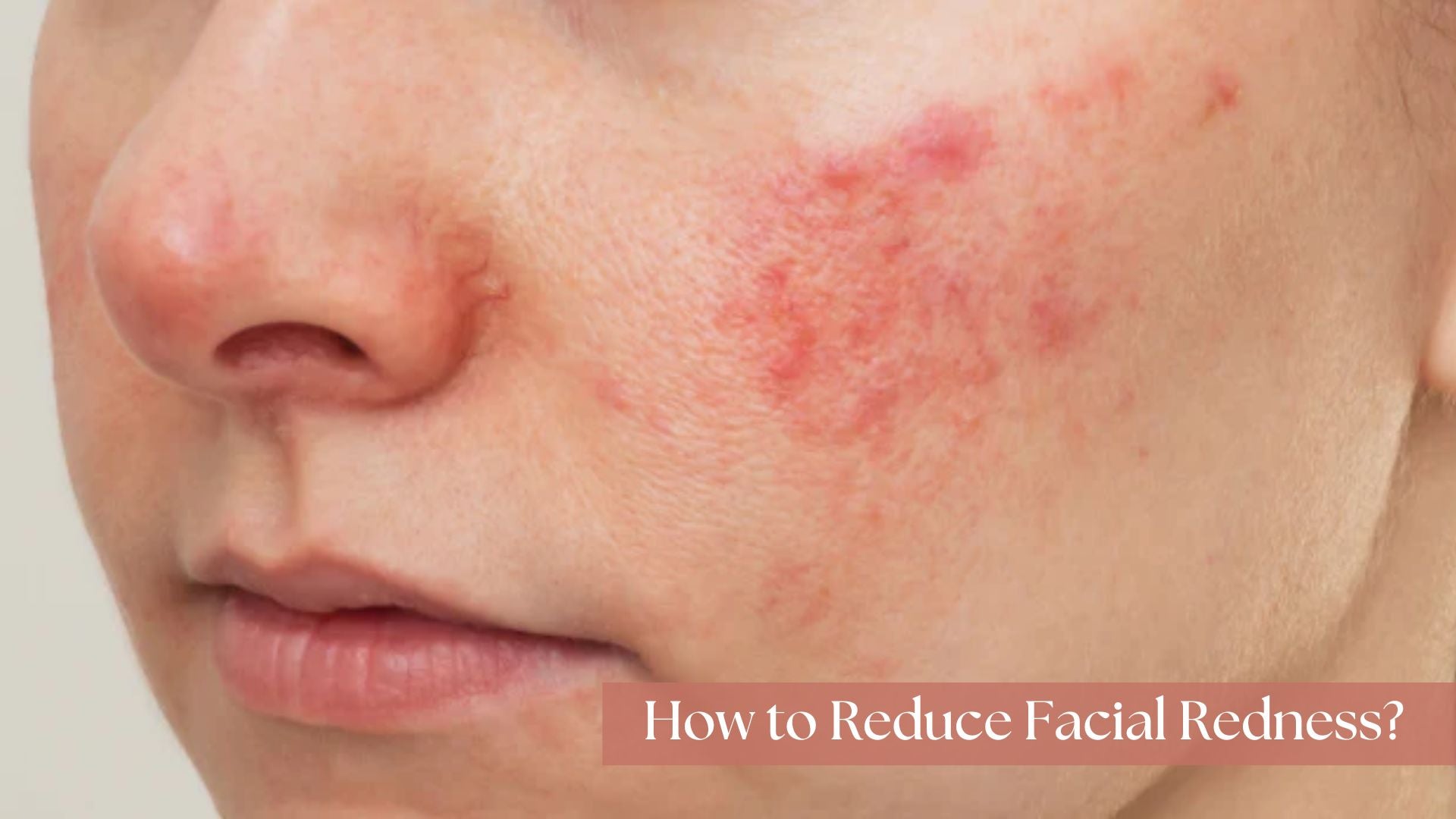 10 Causes You Have Skin Facial Redness & How to Reduce It