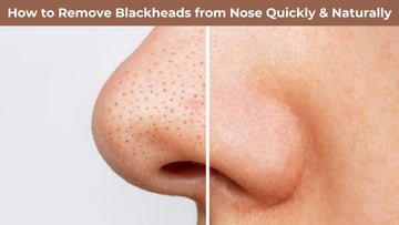 How to Remove Blackheads from Nose Quickly & Naturally by Club Derma