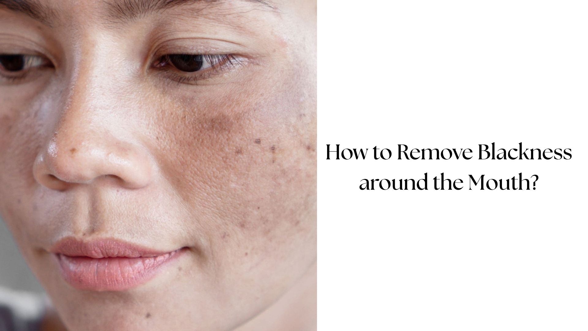 How to Remove Blackness around the Mouth by Club Derma